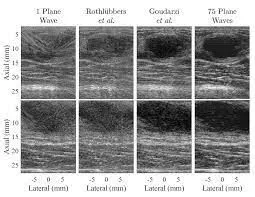 Comparison of planewave reconstructions on in vivo data