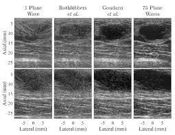 Comparison of planewave reconstructions on in vivo data