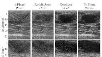 CUBDL: Challenge on Ultrasound Beamforming with Deep Learning featured image