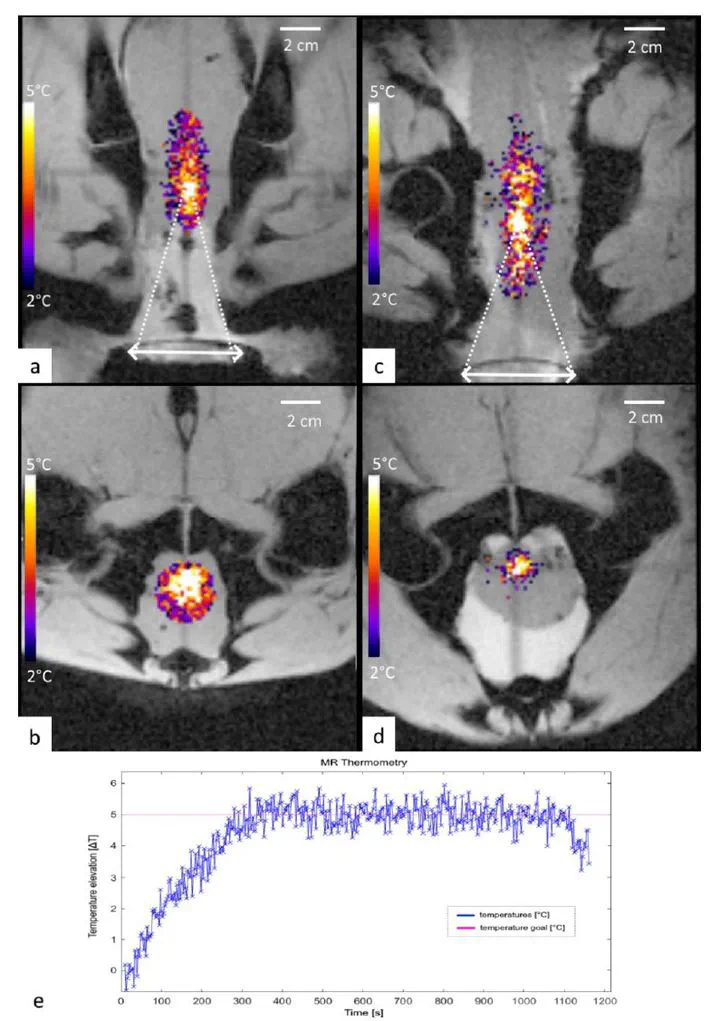 Image of MRI thermometry showing focal heating