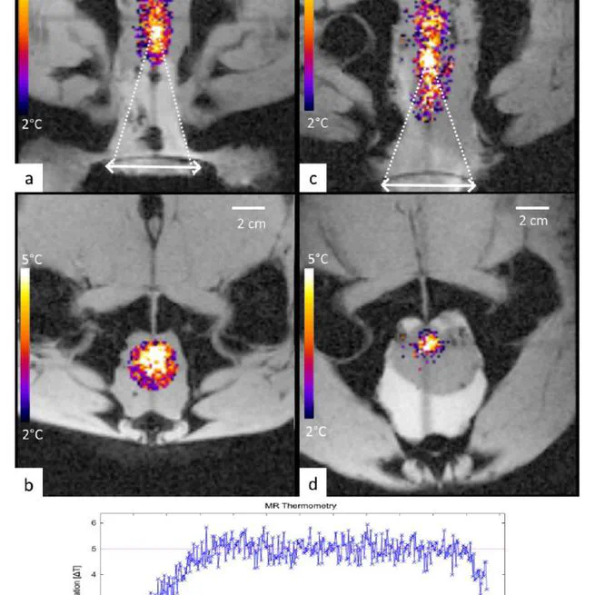 A novel concept of transperineal focused ultrasound transducer for prostate cancer local deep hyperthermia treatments