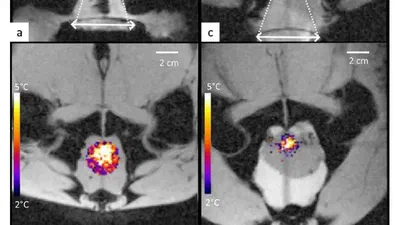 A novel concept of transperineal focused ultrasound transducer for prostate cancer local deep hyperthermia treatments featured image