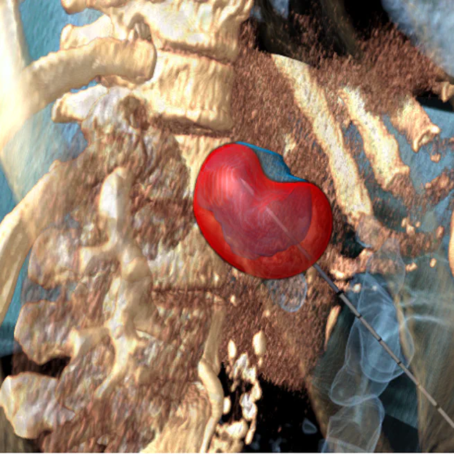 Patient-Specific Modelling of Microwave Ablation