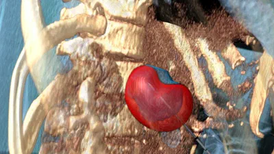 Patient-Specific Modelling of Microwave Ablation featured image